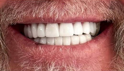 After whitening treatment at Bhati Dental Clinic